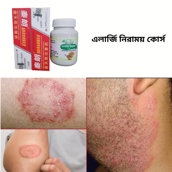 এলার্জি-চর্মরোগ নিরাময় কোর্স - Allergy-niramoy - Image 3