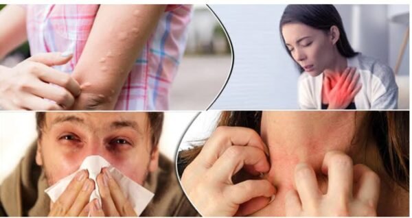 এলার্জি-চর্মরোগ নিরাময়-Allergy-niramoy - Image 2