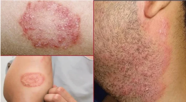 এলার্জি-চর্মরোগ নিরাময়-Allergy-niramoy - Image 3