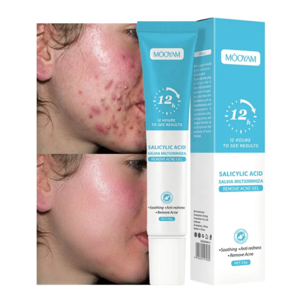 Remove Acne Gel – Salicylic Acid [2 Piece] - Image 3