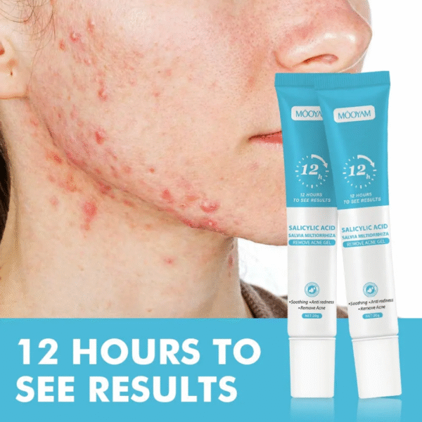 Remove Acne Gel – Salicylic Acid [2 Piece] - Image 4