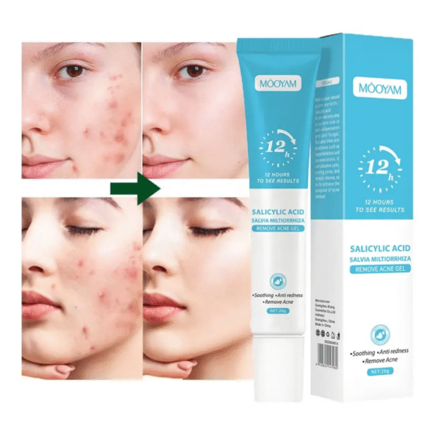 Remove Acne Gel – Salicylic Acid [2 Piece] - Image 5