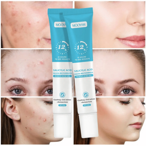 Remove Acne Gel – Salicylic Acid [2 Piece] - Image 6